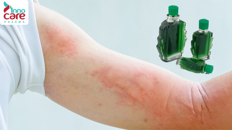 Cách xua đuổi muỗi bằng dầu gió