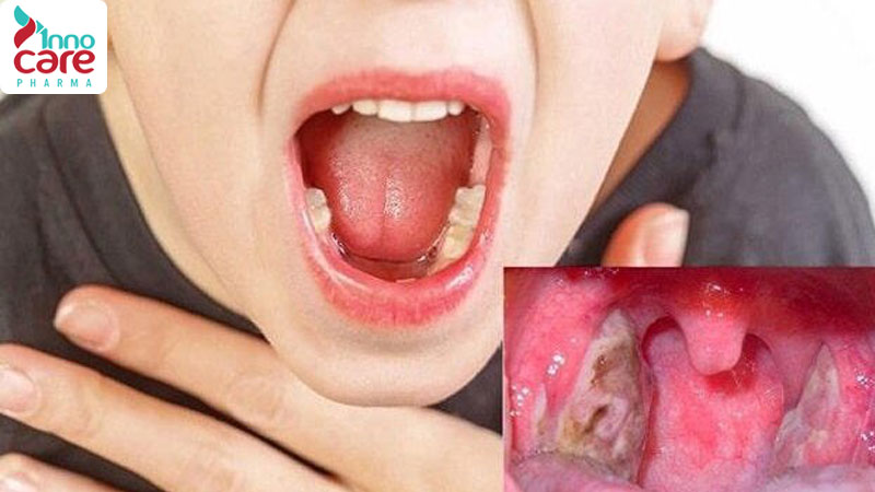 Cách chữa viêm họng cho trẻ tại nhà an toàn và hiệu quả