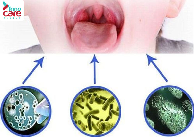 1. Vi khuẩn gây viêm họng 1 nguyên nhân nuốt nước bọt đau họng và cách phòng tránh