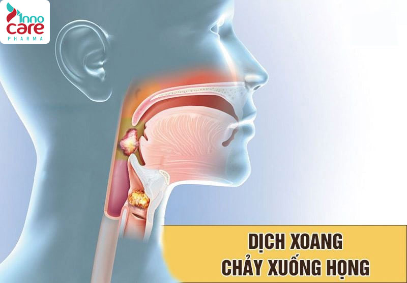 7. Các nguyên nhân khác 1 nguyên nhân nuốt nước bọt đau họng và cách phòng tránh