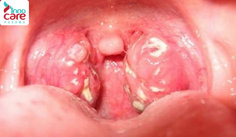3. Áp xe quanh amidan 1 Lý do nuốt nước bọt đau họng bên phải và cách xử lý