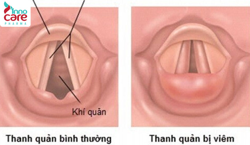 5. Viêm nắp thanh quản (epiglottitis) 1 Lý do nuốt nước bọt đau họng bên phải và cách xử lý