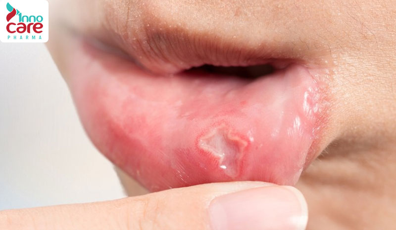 7. Loét miệng 1 Lý do nuốt nước bọt đau họng bên phải và cách xử lý