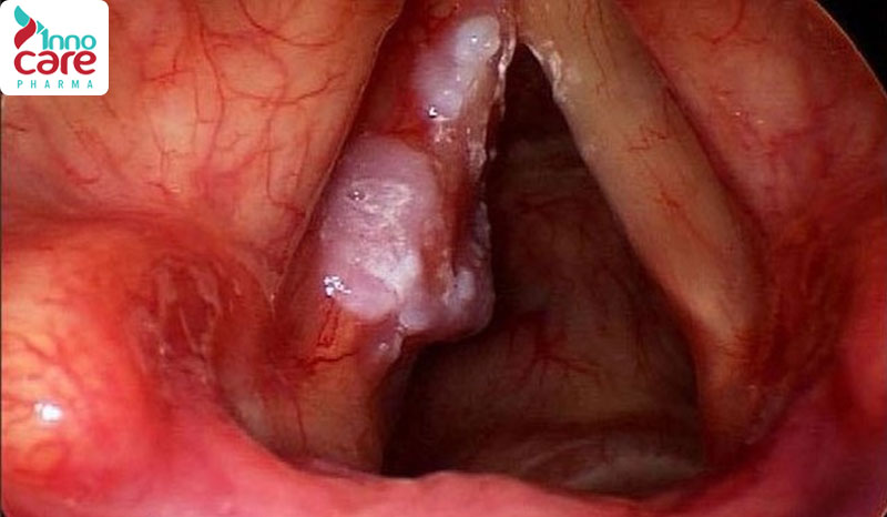 9. Khối u vùng họng – thanh quản 1 Lý do nuốt nước bọt đau họng bên phải và cách xử lý