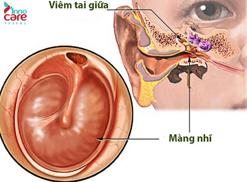 Nguyên nhân và cách chữa nuốt nước bọt đau họng bên trái