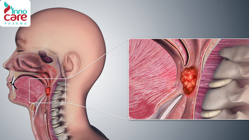 Nguyên nhân và cách chữa nuốt nước bọt đau họng bên trái