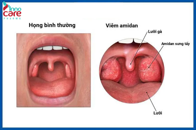 Nguyên nhân gây đau họng khi nuốt nước bọt 1 Nuốt nước bọt đau họng uống thuốc gì?