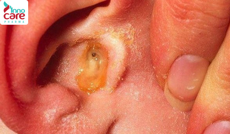 Nhiễm trùng tai ngoài 1 Nuốt nước bọt đau tai: nguyên nhân và cách xử lý