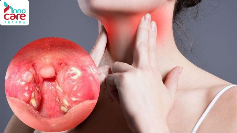 Các bệnh lý thường gặp gây nuốt nước bọt bị vướng 1