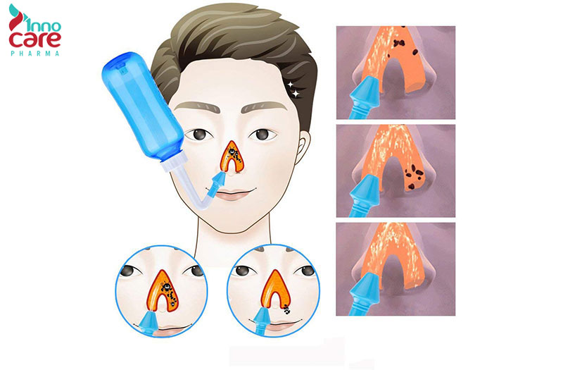 Bước 3: Cách đưa dung dịch vào mũi 1 Hướng dẫn cách rửa mũi cho người lớn sạch sẽ, an toàn