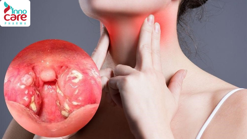 Viêm họng mãn tính: Nguyên nhân, triệu chứng và cách điều trị