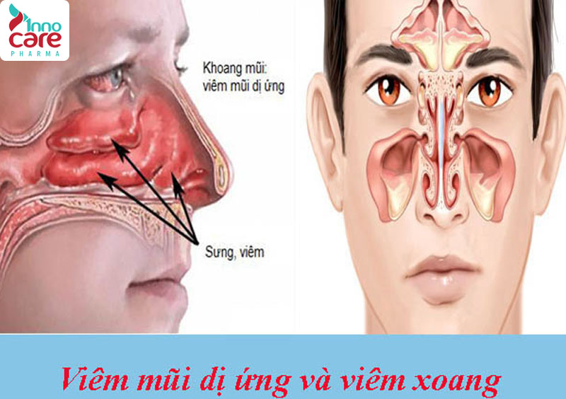 Phân biệt viêm mũi dị ứng với các bệnh mũi khác 1 Viêm mũi dị ứng: Nguyên nhân, dấu hiệu nhận biết và cách điều trị