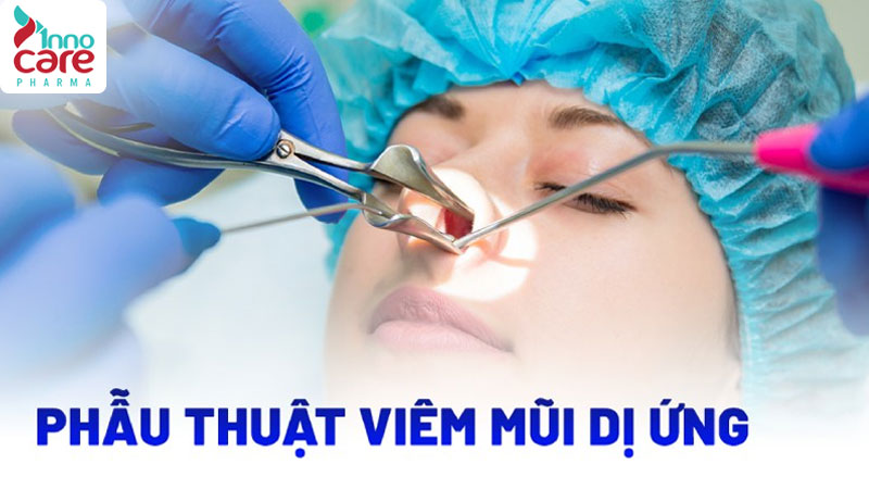 3. Phẫu thuật hỗ trợ 1 Viêm mũi dị ứng: Nguyên nhân, dấu hiệu nhận biết và cách điều trị
