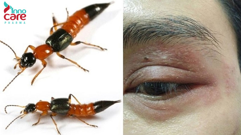 Cách chữa kiến ba khoang đốt an toàn và hiệu quả nhanh