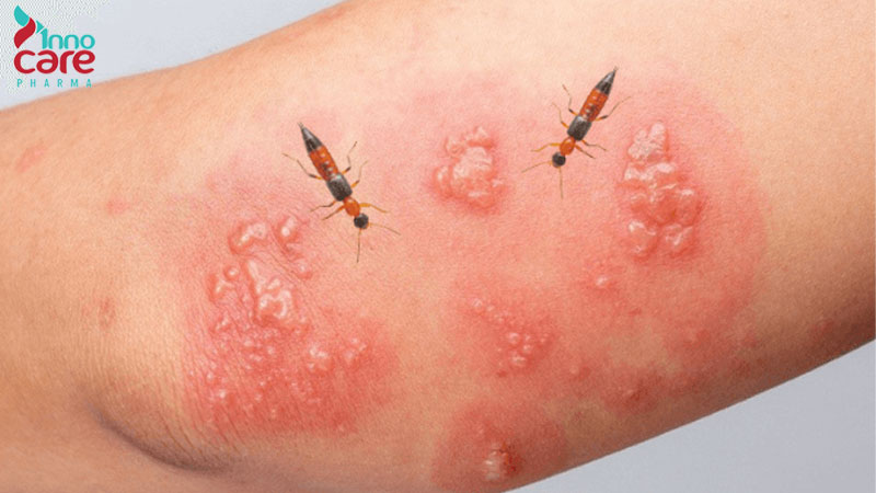 Cách chữa kiến ba khoang đốt an toàn và hiệu quả nhanh