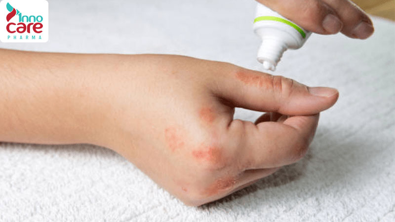 Bước 3: Sử dụng thuốc bôi hỗ trợ phù hợp 1 Bị kiến cắn nổi mụn nước và cách xử lý an toàn, hiệu quả nhất