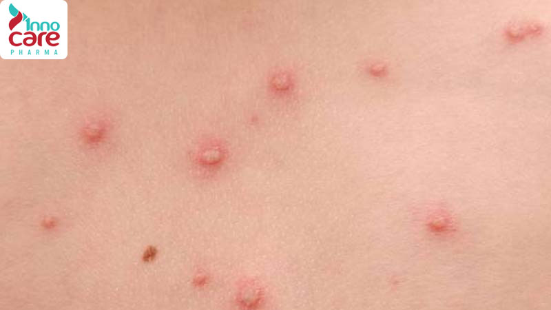 Vì sao trẻ em thường bị phản ứng nặng hơn khi kiến cắn? 1 Bị kiến cắn nổi mụn nước và cách xử lý an toàn, hiệu quả nhất