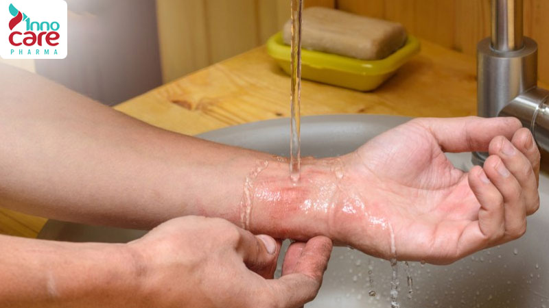 Bước 1: Sơ cứu ngay lập tức vùng da bị kiến cắn 1 Bị kiến cắn nổi mụn nước và cách xử lý an toàn, hiệu quả nhất