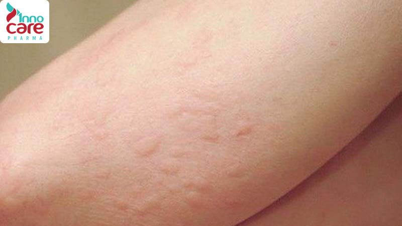 Kiến đen, kiến vàng 1 Bị kiến cắn sưng phù: Cách xử lý hiệu quả nhanh và an toàn