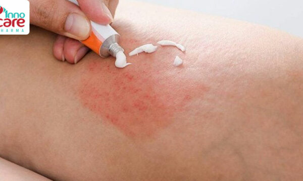 Kiến cánh có độc không? Cách xử lý khi bị kiến cánh cắn