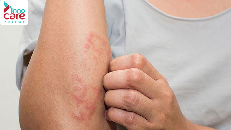 Kiến cánh có độc không? Cách xử lý khi bị kiến cánh cắn