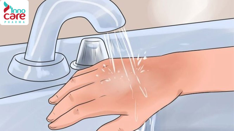 Kiến lửa cắn có sao không? Cách trị kiến lửa cắn hiệu quả nhất