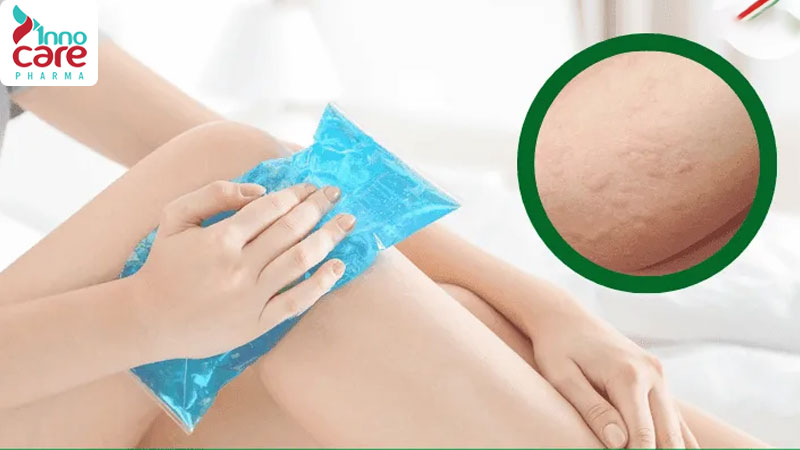 Bước 2: Chườm lạnh để giảm sưng nhanh 1 Bị kiến cắn sưng phù: Cách xử lý hiệu quả nhanh và an toàn