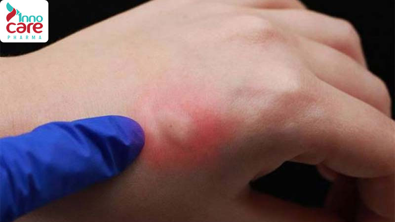 Bước 2: Loại bỏ kiến đang bám trên người đúng cách, tránh làm axit lan rộng 1 Kiến vàng cắn có sao không? Mẹo trị kiến vàng cắn tại nhà nhanh