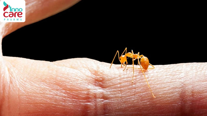 Kiến vàng cắn có sao không? Những biểu hiện thường gặp 1 Kiến vàng cắn có sao không? Mẹo trị kiến vàng cắn tại nhà nhanh