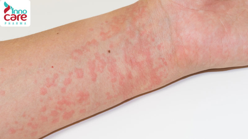 Bị nổi mẩn đỏ ngứa như kiến cắn là bị gì? Cách xử lý thế nào?