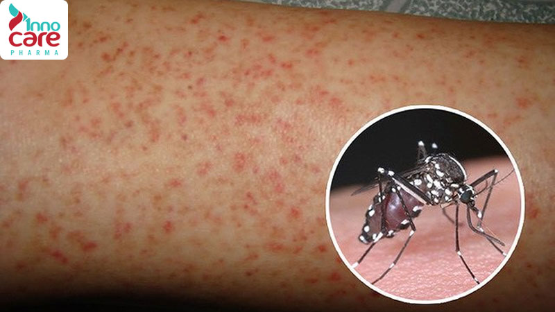 Sốt xuất huyết Dengue 1 Bị muỗi đốt nhiều có sao không?