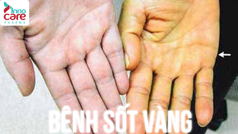 Sốt vàng da 1 Bị muỗi đốt nhiều có sao không?