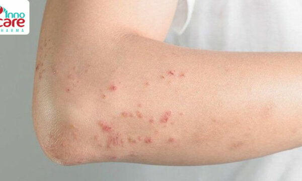 Bị muỗi đốt nhiều có sao không?