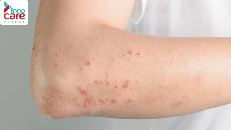 Giải đáp: Bị muỗi đốt nhiều có sao không? 1 Bị muỗi đốt nhiều có sao không?