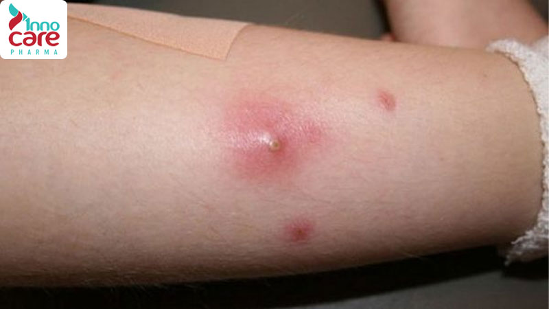 Bị muỗi đốt sưng to có mủ và mỏng nước chớ nên coi thường