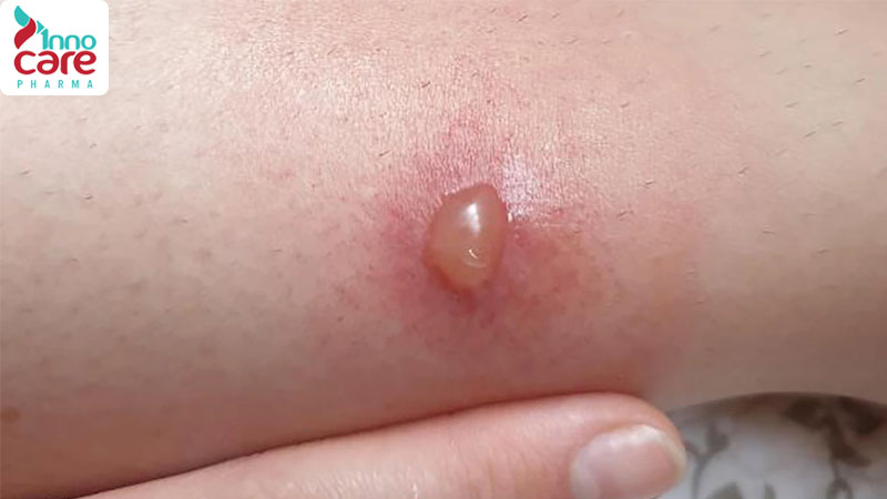 Bị muỗi đốt sưng to có mủ và mỏng nước chớ nên coi thường