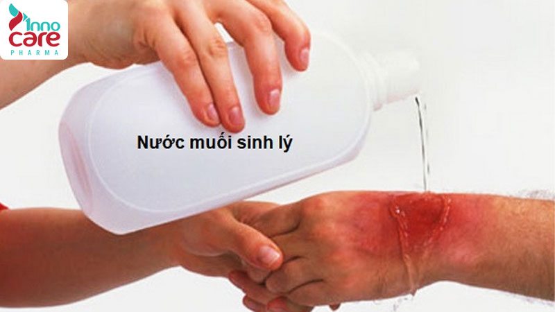 Bị muỗi đốt sưng to có mủ và mỏng nước chớ nên coi thường