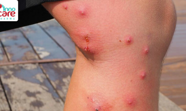 Bị muỗi đốt sưng to có mủ và mỏng nước chớ nên coi thường