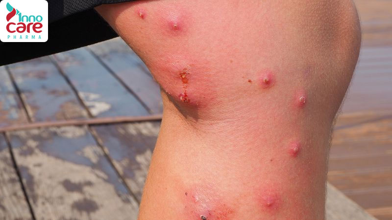 Bị muỗi đốt sưng to có mủ và mỏng nước chớ nên coi thường