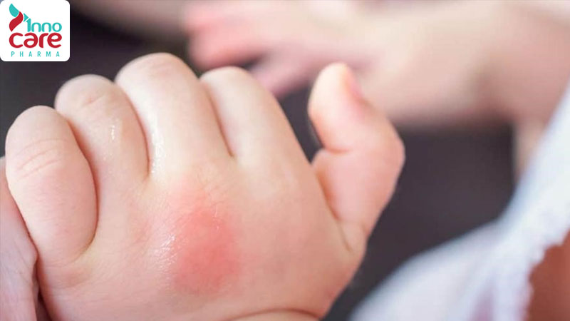 Cách trị muỗi đốt sưng đỏ cho bé an toàn và nhanh khỏi