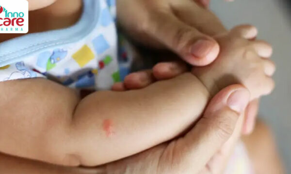 Cách trị muỗi đốt sưng đỏ cho bé an toàn và nhanh khỏi