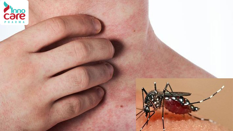 Cách trị vết muỗi đốt nhanh lành và cực kỳ hiệu quả