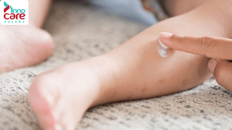 Cách trị vết muỗi đốt nhanh lành và cực kỳ hiệu quả