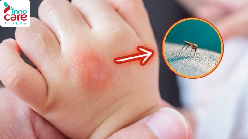 Tại sao muỗi đốt để lại chấm đỏ không ngứa hoặc ngứa