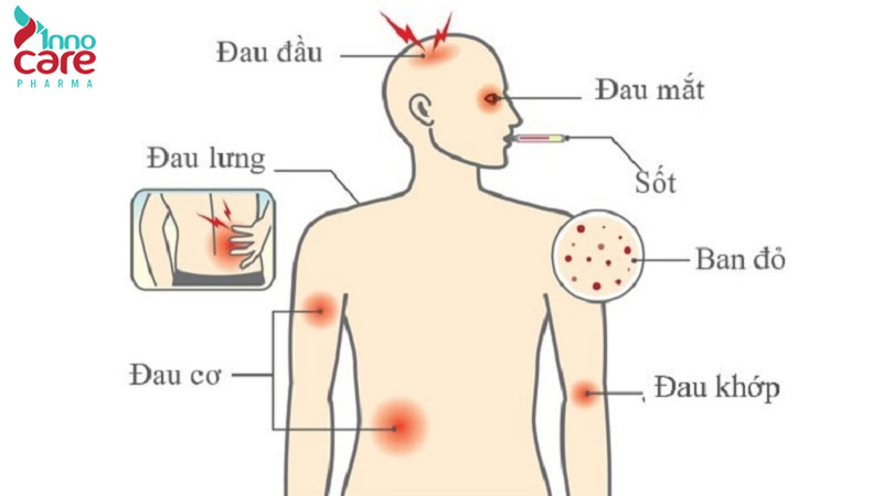 2. Dấu hiệu nhiễm virus sốt xuất huyết (sau 4–7 ngày) 1 Dấu hiệu nhận biết muỗi đốt sốt xuất huyết và cách xử lý