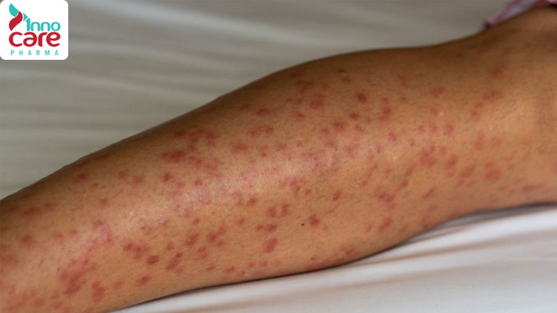 Cách xử lý khi bị muỗi đốt sưng to nhanh xẹp nhất