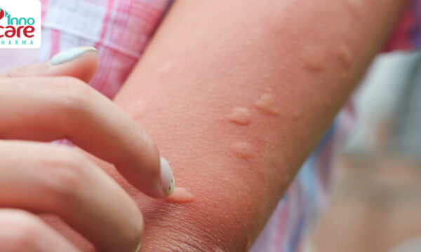 Cách xử lý khi bị muỗi đốt sưng to nhanh xẹp nhất