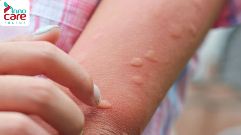 Cách xử lý khi bị muỗi đốt sưng to nhanh xẹp nhất