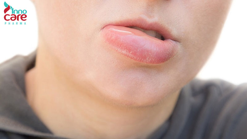 Mẹo xử lý khi bị muỗi đốt vào môi hiệu quả nhanh