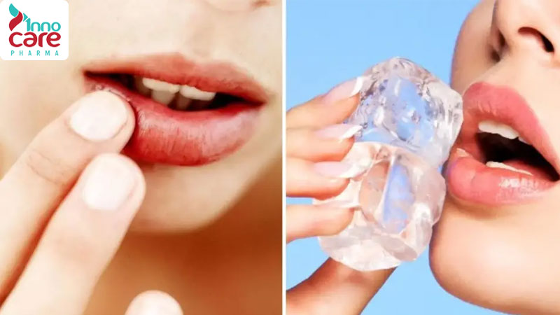 Mẹo xử lý khi bị muỗi đốt vào môi hiệu quả nhanh